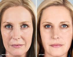 How Sculptra Rebuilds Collagen: Non-surgical Facelift